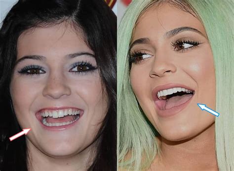 kylie jenner before and after teeth